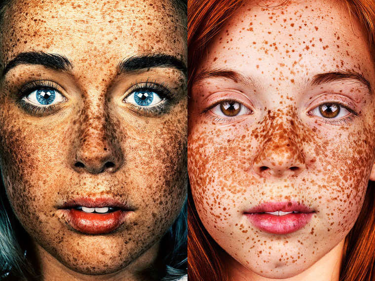 Lang leben Sommersprossen! Mr-Elbank-Sommersprossen_01