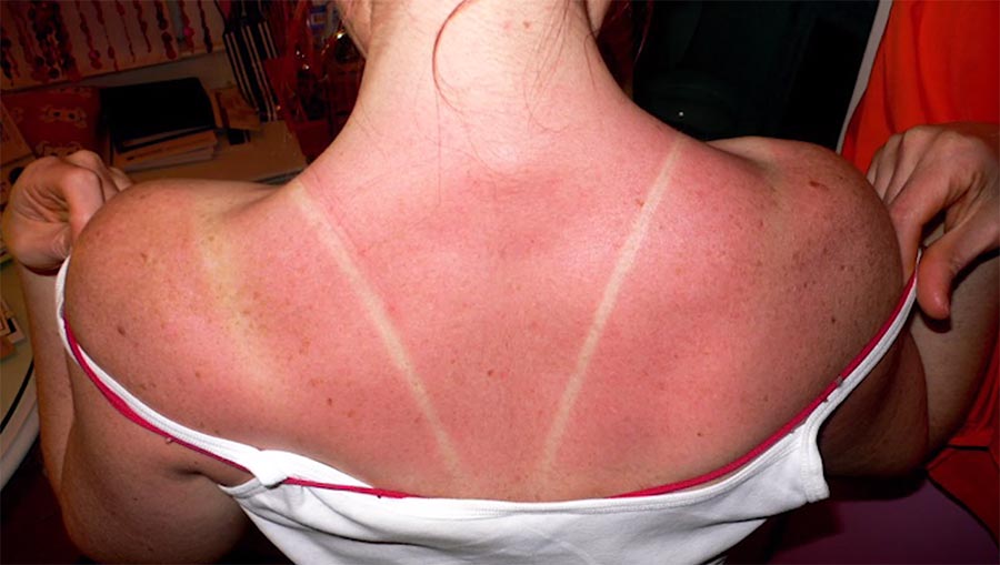 Wie entsteht eigentlich ein Sonnenbrand? what-causes-sunburn 