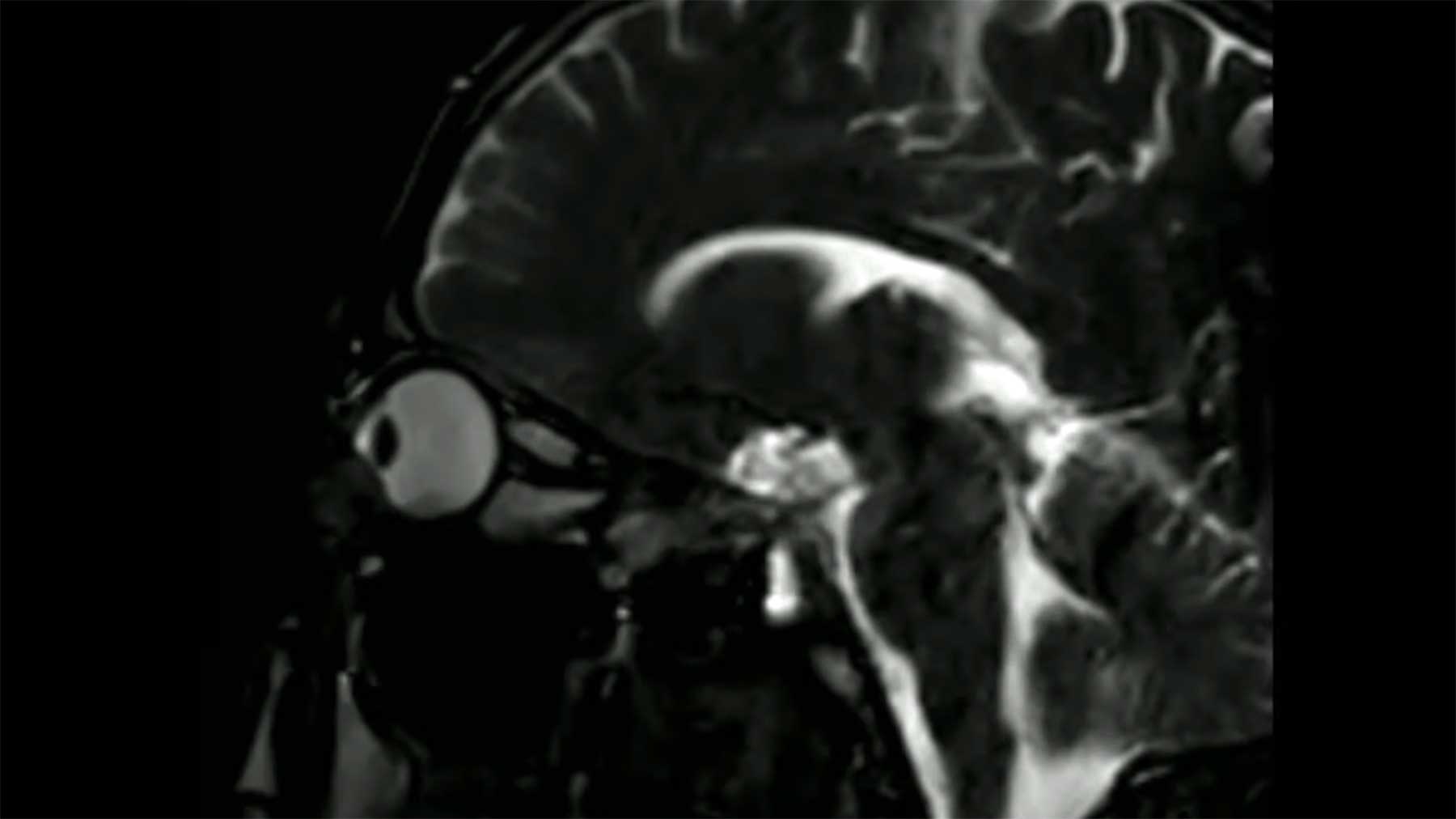 So sieht Augenreiben im MRI-Bild aus