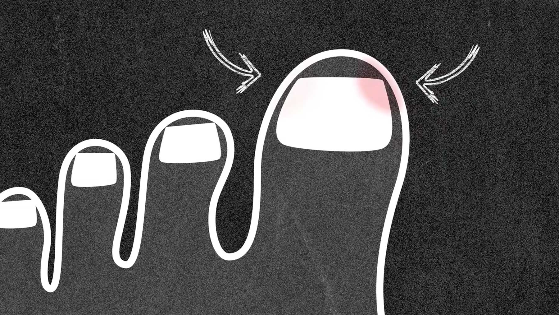 Weshalb man die Zehennägel gerade schneiden sollte fussmythen-zehennaegel-abschneiden 